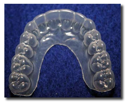 Essix Retainer as a protective applicance for a dental implant